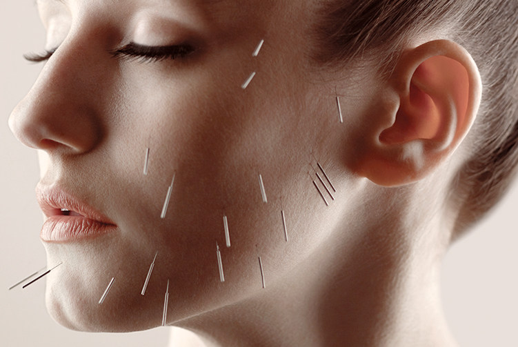 Is Acupunture A Good Way To Treat Acne