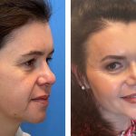 Unlocking Confidence: The Art Of Rhinoplasty And Facelift Procedures